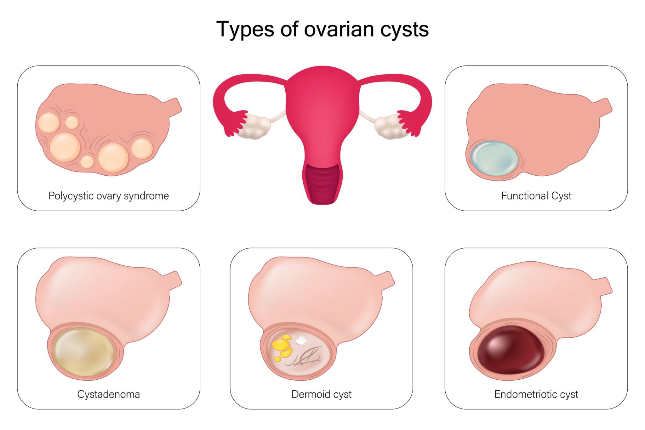 Laparoscopic Dermoid Cyst Removal in Pune – Safe & Minimally Invasive Treatment